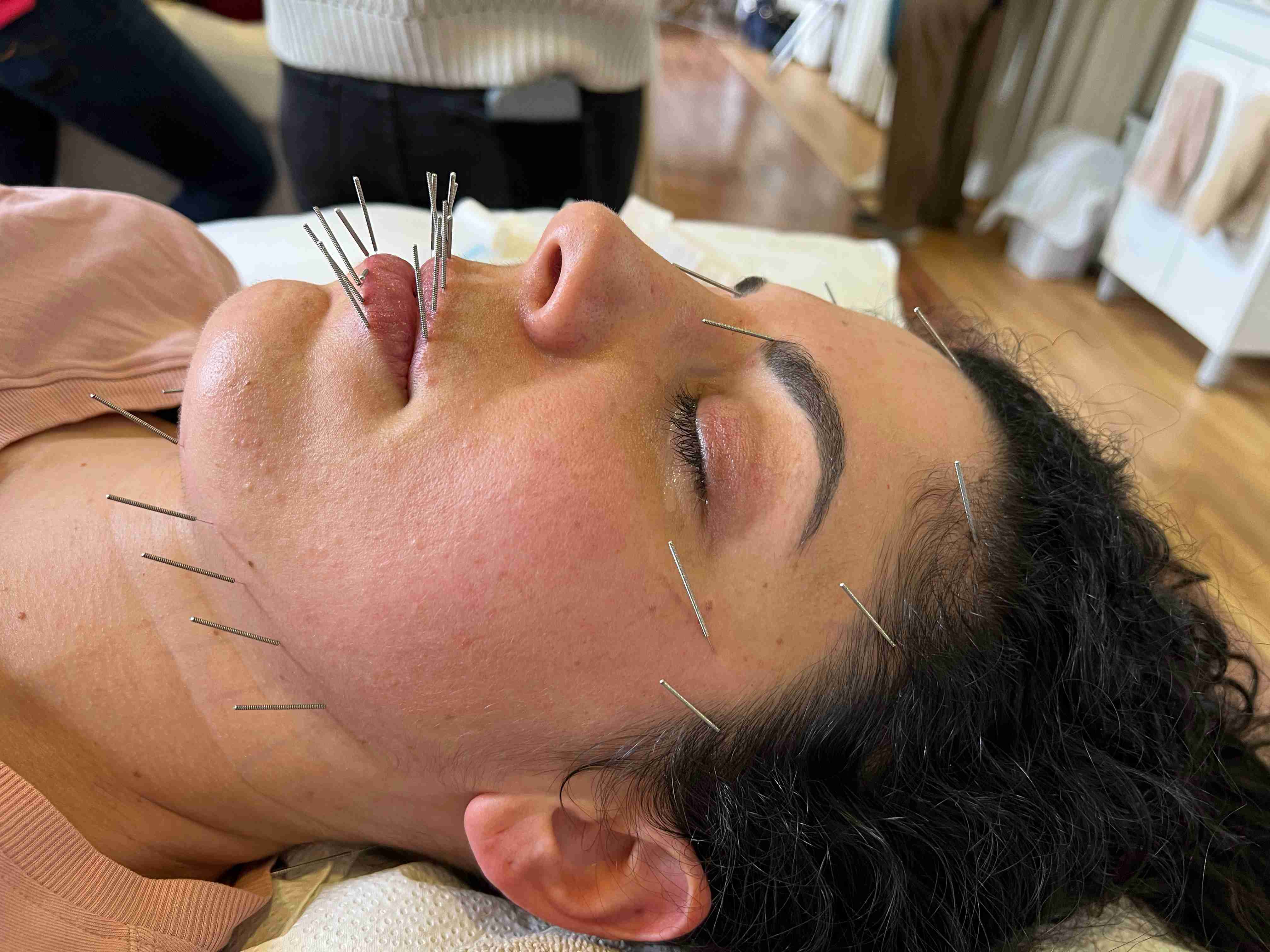 Person with facial acupuncture